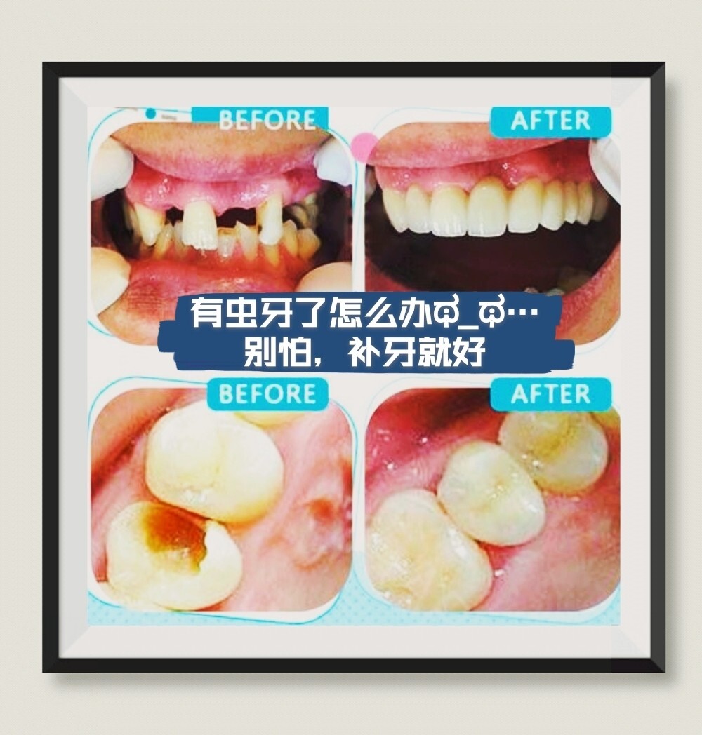 虫牙是真有虫子吗虫牙真的是牙齿有虫吗？——揭秘蚂蚁庄园的口腔健康知识-第3张图片