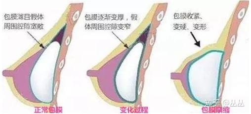 隆胸打针隆胸打针，现代女性的美丽秘诀