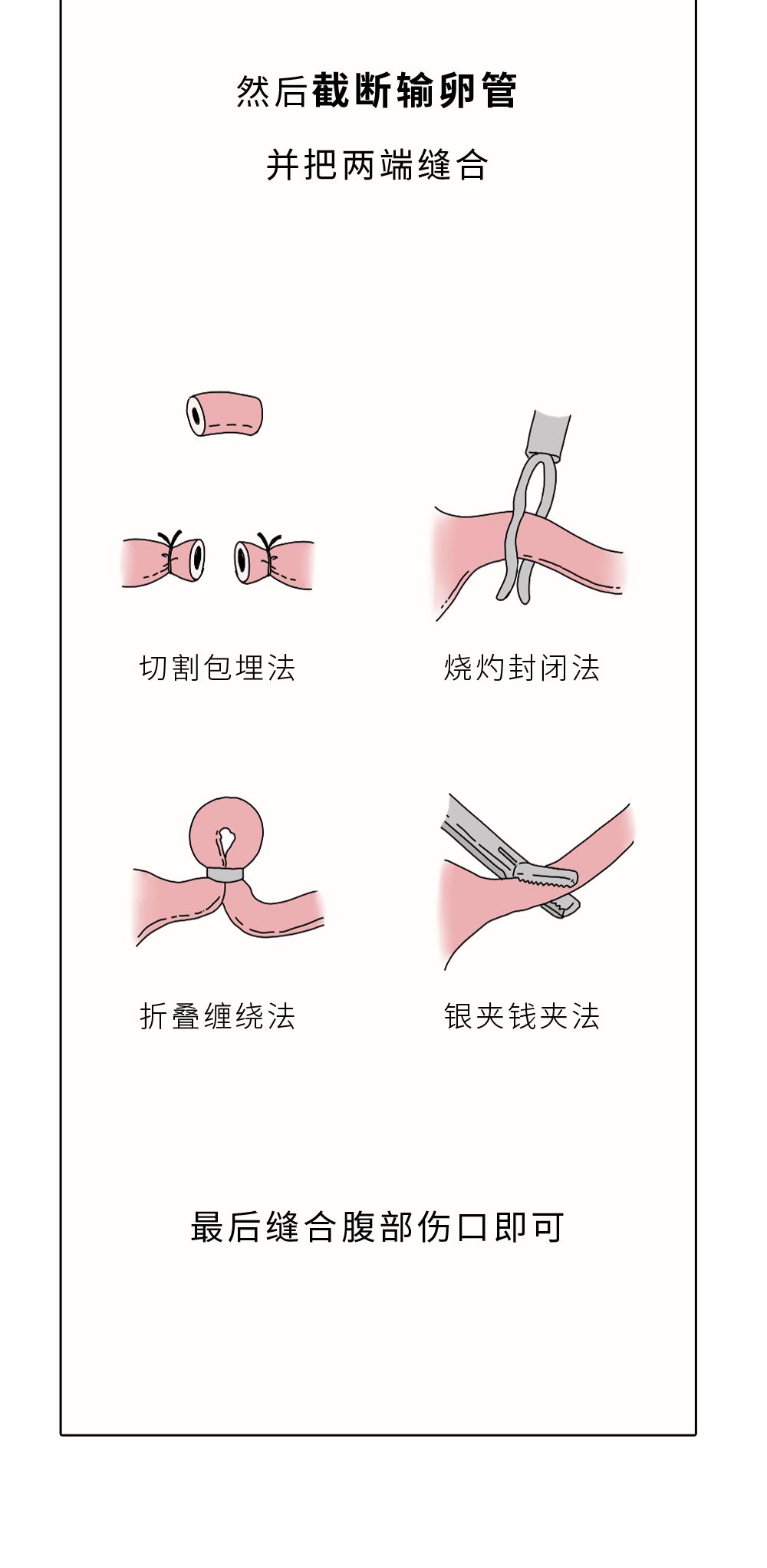 妈妈结扎后的生活新篇章