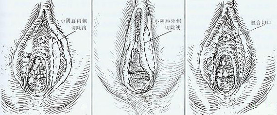 又大又广探索女性私密部位——大荫蒂的独特魅力-第3张图片