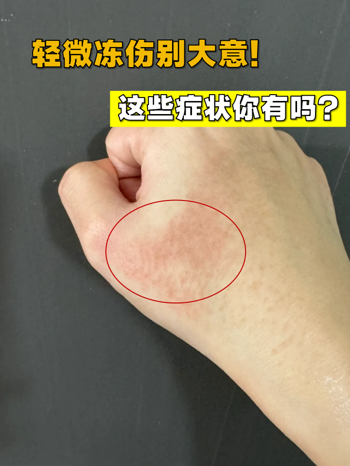 冻结冰骨在哪获取冻伤的预防与治疗，成就与行动-第2张图片