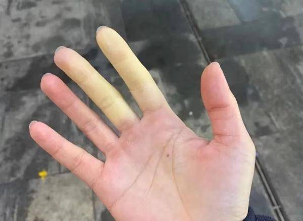 一个手指头就疼成这样视频一指之痛，从微小细节看疼痛的巨大影响——一个手指头就疼成这样视频的启示