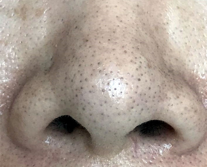 粗大黑头紫与大黑头紫的舒适之旅