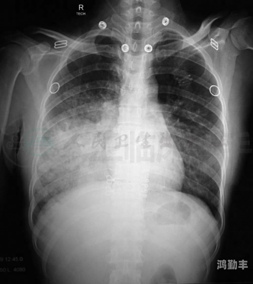 100%胸片曝光全面解析100%胸片曝光，技术、应用与未来展望-第3张图片