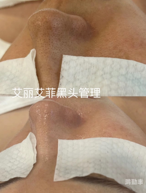粗大黑头与紫大黑头，挤出的困扰与应对策略