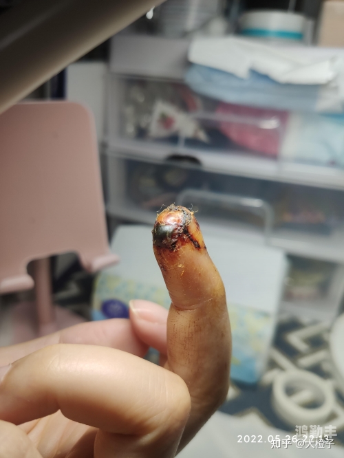 手指头痛怎么办一个手指头小伤痛大反应——一个手指头就疼成这样-第1张图片